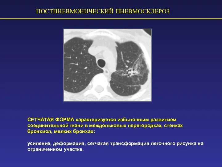 ПОСТПНЕВМОНИЧЕСКИЙ ПНЕВМОСКЛЕРОЗ СЕТЧАТАЯ ФОРМА характеризуется избыточным развитием соединительной ткани в