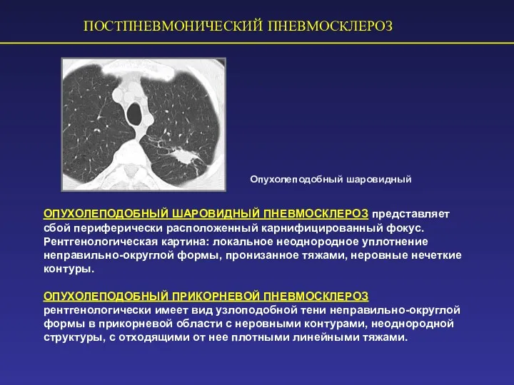 ПОСТПНЕВМОНИЧЕСКИЙ ПНЕВМОСКЛЕРОЗ Опухолеподобный шаровидный ОПУХОЛЕПОДОБНЫЙ ШАРОВИДНЫЙ ПНЕВМОСКЛЕРОЗ представляет сбой периферически