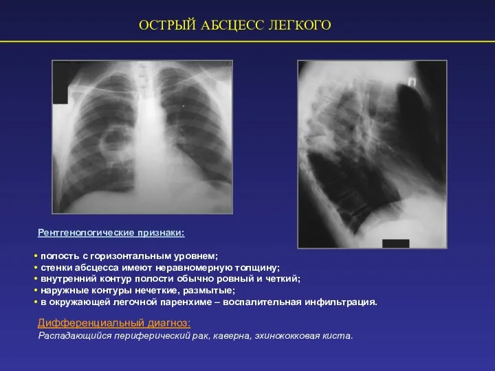 ОСТРЫЙ АБСЦЕСС ЛЕГКОГО Рентгенологические признаки: полость с горизонтальным уровнем; стенки