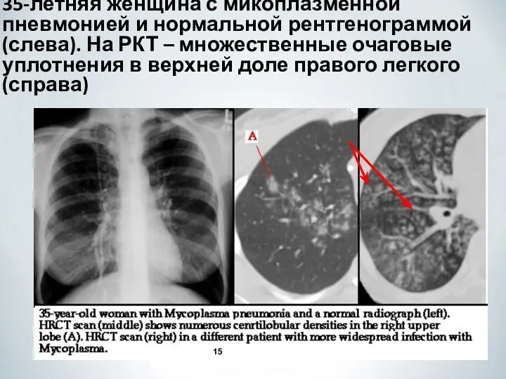 35-летняя женщина с микоплазменной пневмонией и нормальной рентгенограммой (слева). На