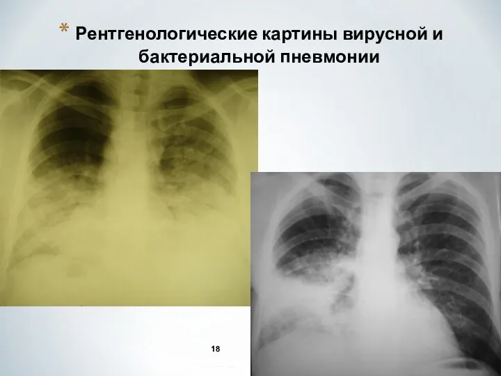 Рентгенологические картины вирусной и бактериальной пневмонии