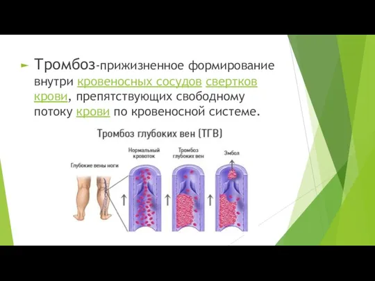 Тромбоз-прижизненное формирование внутри кровеносных сосудов свертков крови, препятствующих свободному потоку крови по кровеносной системе.