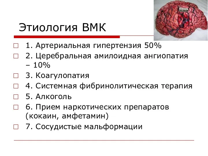 Этиология ВМК 1. Артериальная гипертензия 50% 2. Церебральная амилоидная ангиопатия