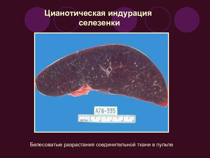 Цианотическая индурация селезенки Белесоватые разрастания соединительной ткани в пульпе