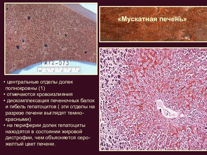 «Мускатная печень» центральные отделы долек полнокровны (1) отмечаются кровоизлияния дискомплексация