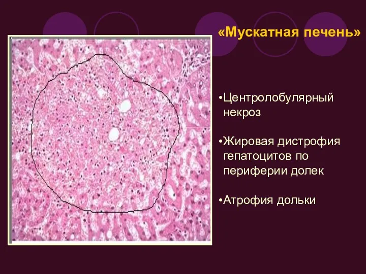 Центролобулярный некроз Жировая дистрофия гепатоцитов по периферии долек Атрофия дольки «Мускатная печень»