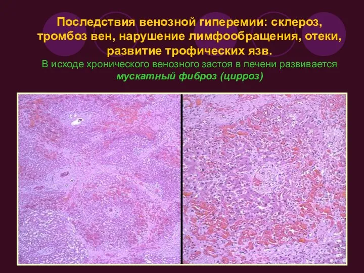 Последствия венозной гиперемии: склероз, тромбоз вен, нарушение лимфообращения, отеки, развитие