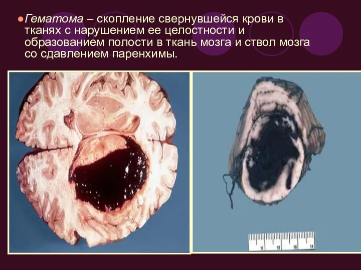 Гематома – скопление свернувшейся крови в тканях с нарушением ее