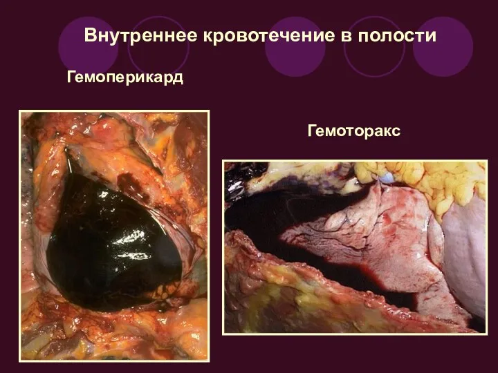 Внутреннее кровотечение в полости Гемоперикард Гемоторакс