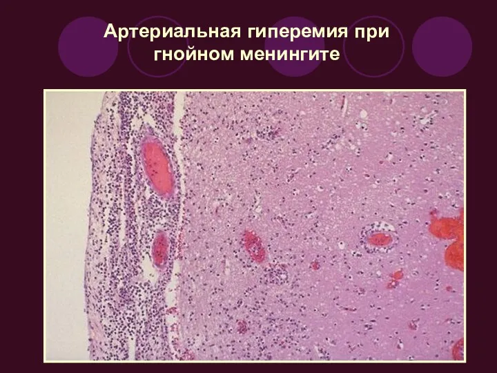 Артериальная гиперемия при гнойном менингите