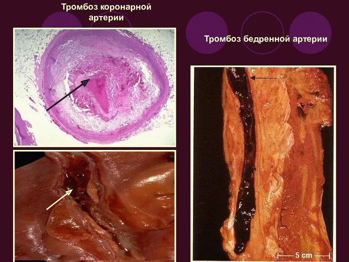 Тромбоз коронарной артерии Тромбоз бедренной артерии