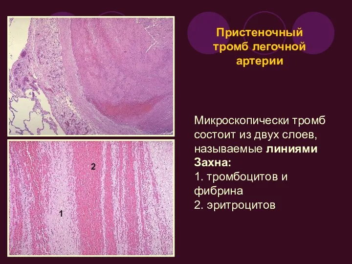 Пристеночный тромб легочной артерии Микроскопически тромб состоит из двух слоев,