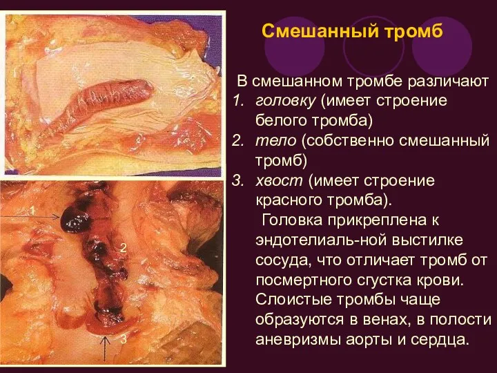 Смешанный тромб В смешанном тромбе различают головку (имеет строение белого