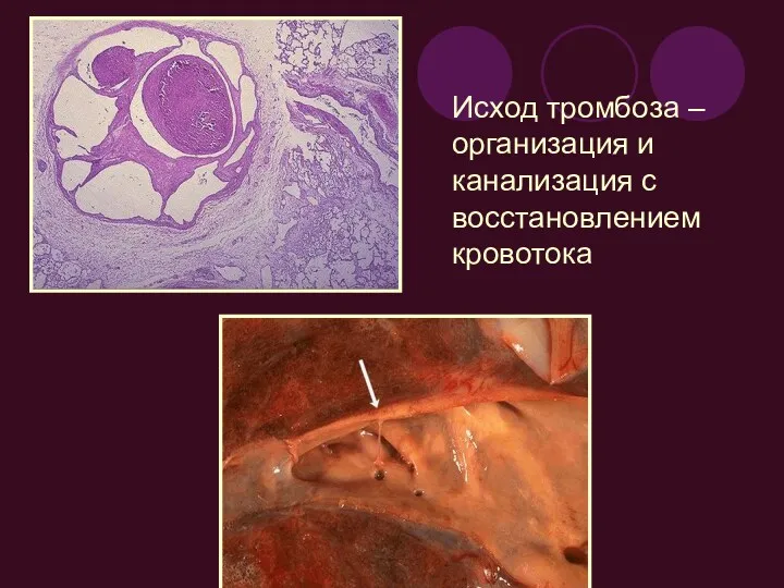 Исход тромбоза – организация и канализация с восстановлением кровотока