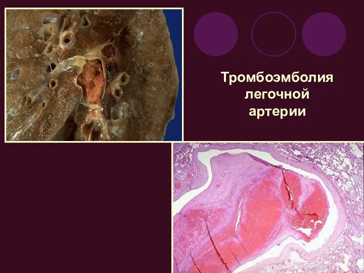 Тромбоэмболия легочной артерии