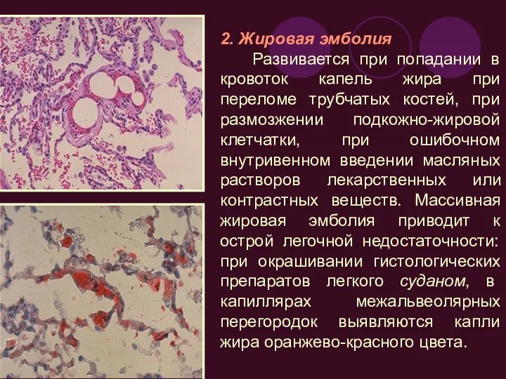 2. Жировая эмболия Развивается при попадании в кровоток капель жира
