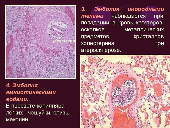 3. Эмболия инородными телами наблюдается при попадании в кровь катетеров,