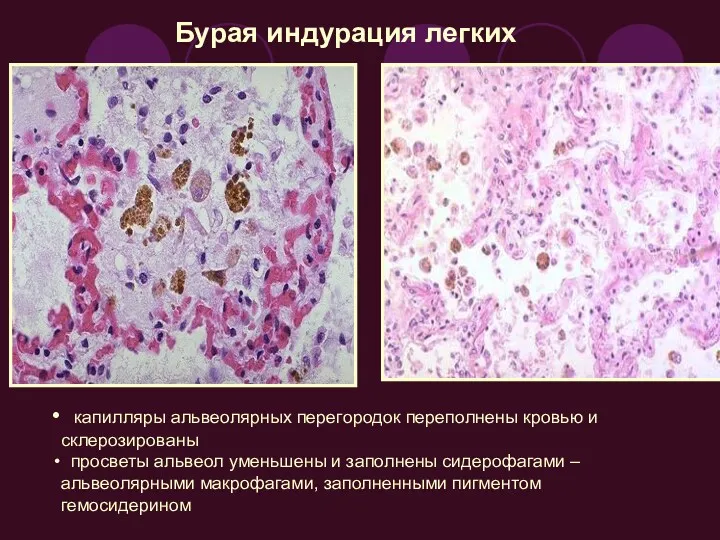 капилляры альвеолярных перегородок переполнены кровью и склерозированы просветы альвеол уменьшены