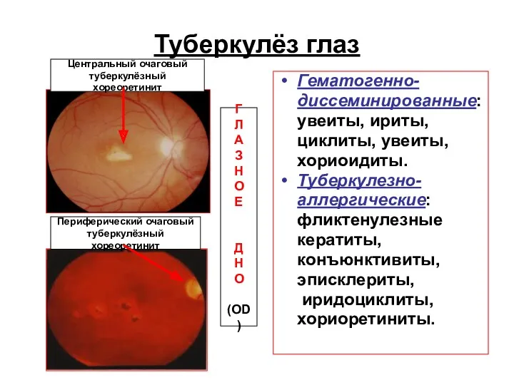 Туберкулёз глаз Гематогенно- диссеминированные: увеиты, ириты, циклиты, увеиты, хориоидиты. Туберкулезно-