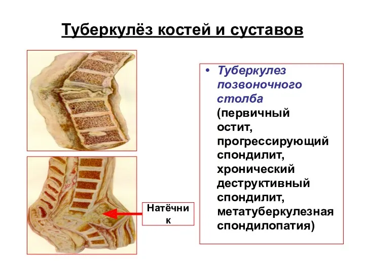 Туберкулёз костей и суставов Туберкулез позвоночного столба (первичный остит, прогрессирующий