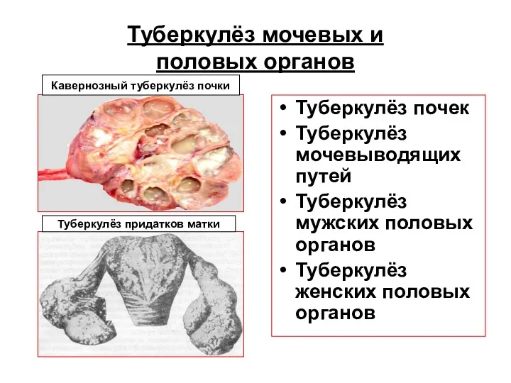 Туберкулёз мочевых и половых органов Туберкулёз почек Туберкулёз мочевыводящих путей