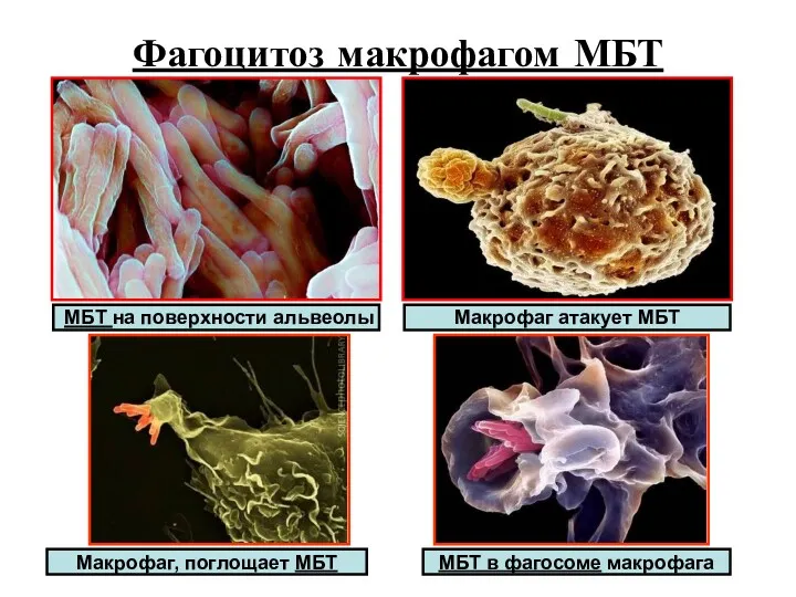Фагоцитоз макрофагом МБТ МБТ на поверхности альвеолы Макрофаг, поглощает МБТ