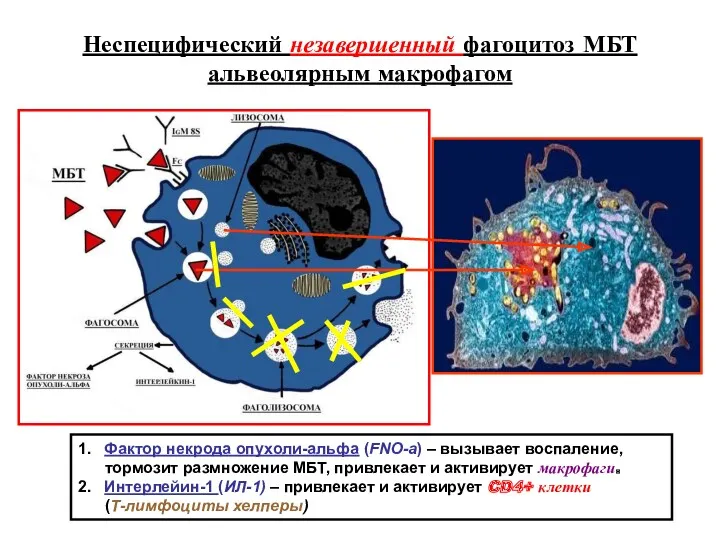 Неспецифический незавершенный фагоцитоз МБТ альвеолярным макрофагом 1. Фактор некрода опухоли-альфа