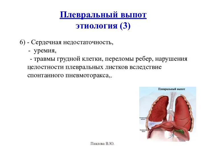 Плевральный выпот этиология (3) 6) - Сердечная недостаточность, - уремия,