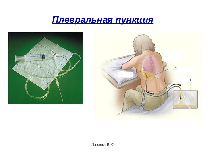 Плевральная пункция Павлова В.Ю.