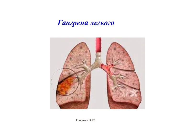Гангрена легкого Павлова В.Ю.