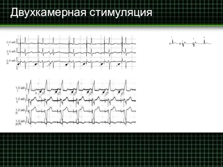 Двухкамерная стимуляция