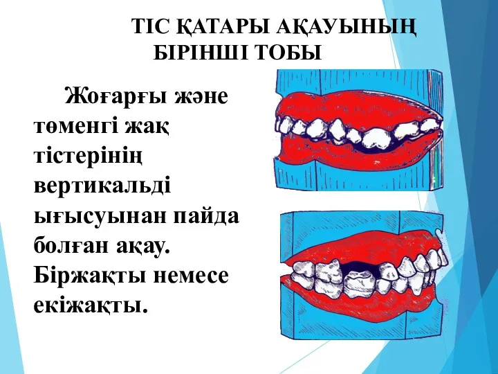 ТІС ҚАТАРЫ АҚАУЫНЫҢ БІРІНШІ ТОБЫ Жоғарғы және төменгі жақ тістерінің вертикальді ығысуынан пайда