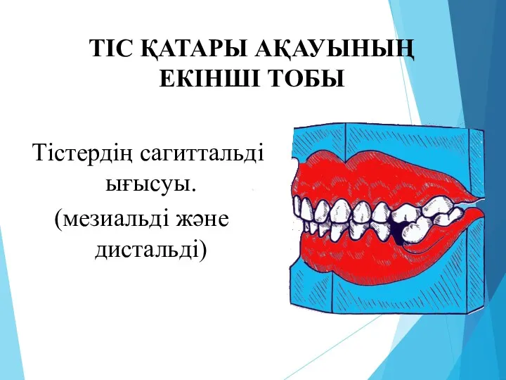 ТІС ҚАТАРЫ АҚАУЫНЫҢ ЕКІНШІ ТОБЫ Тістердің сагиттальді ығысуы. (мезиальді және дистальді)