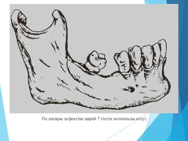 Тіс қатары дефектіне қарай 7 тістің мезиальды иілуі.
