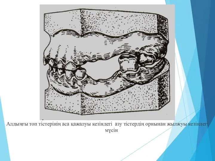 Алдыңғы топ тістерінің аса қажалуы кезіндегі азу тістердің орнынан жылжуы кезіндегі мүсін