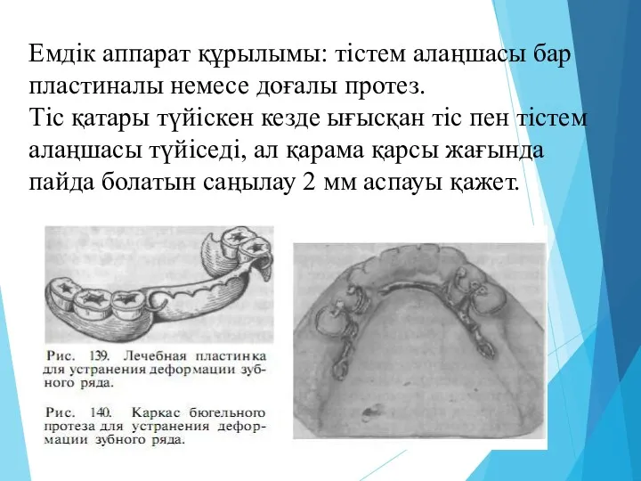 Емдік аппарат құрылымы: тістем алаңшасы бар пластиналы немесе доғалы протез. Тіс қатары түйіскен