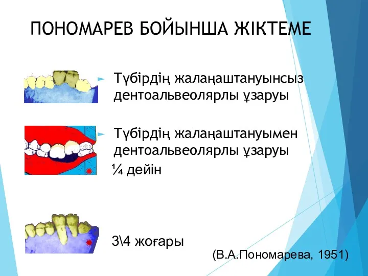 ПОНОМАРЕВ БОЙЫНША ЖІКТЕМЕ Түбірдің жалаңаштануынсыз дентоальвеолярлы ұзаруы Түбірдің жалаңаштануымен дентоальвеолярлы ұзаруы (В.А.Пономарева, 1951)