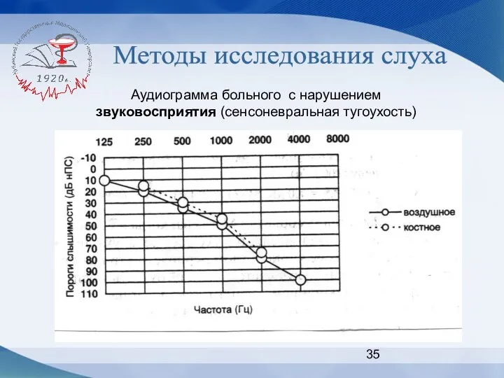 Методы исследования слуха Аудиограмма больного с нарушением звуковосприятия (сенсоневральная тугоухость)