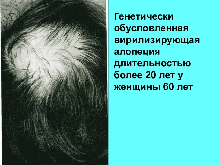 Генетически обусловленная вирилизирующая алопеция длительностью более 20 лет у женщины 60 лет