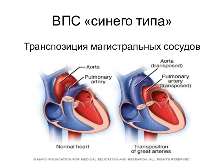 ВПС «синего типа» Транспозиция магистральных сосудов