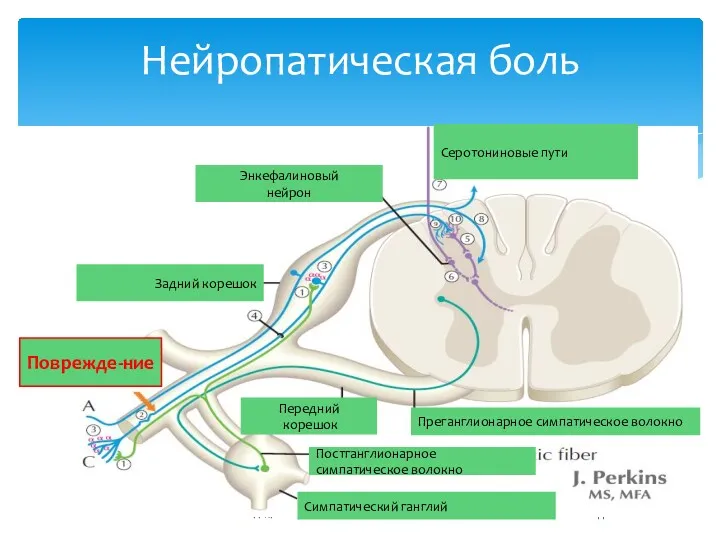 Нейропатическая боль PPRP Поврежде-ние Задний корешок Передний корешок Энкефалиновый нейрон