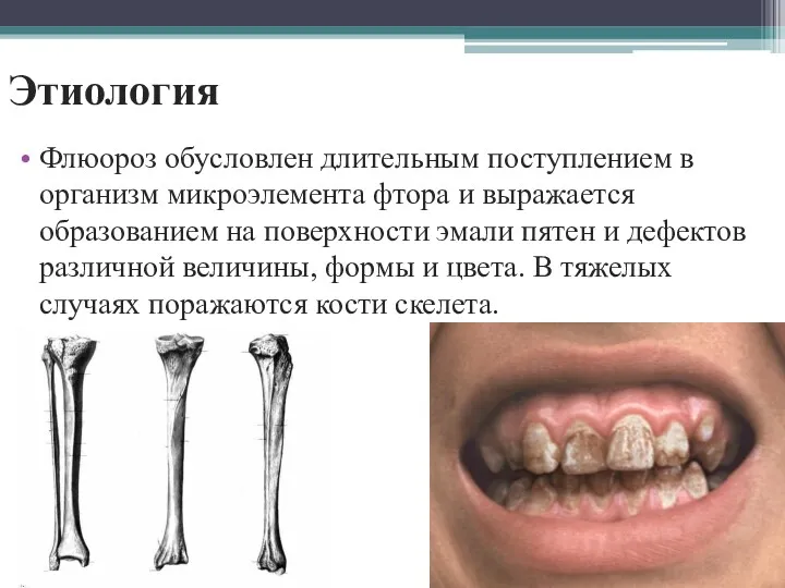 Этиология Флюороз обусловлен длительным поступлением в организм микроэлемента фтора и