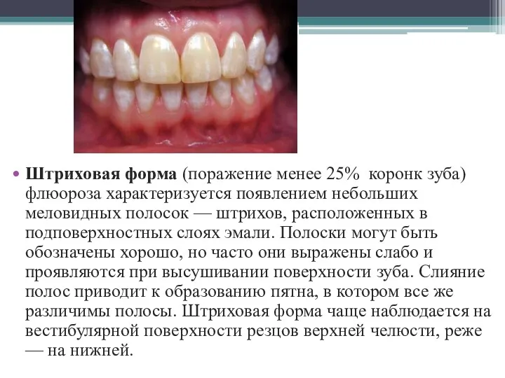 Штриховая форма (поражение менее 25% коронк зуба) флюороза характеризуется появлением