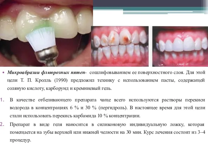 Микроабразии флюорозных пятен- сошлифовыванием ее поверхностного слоя. Для этой цели