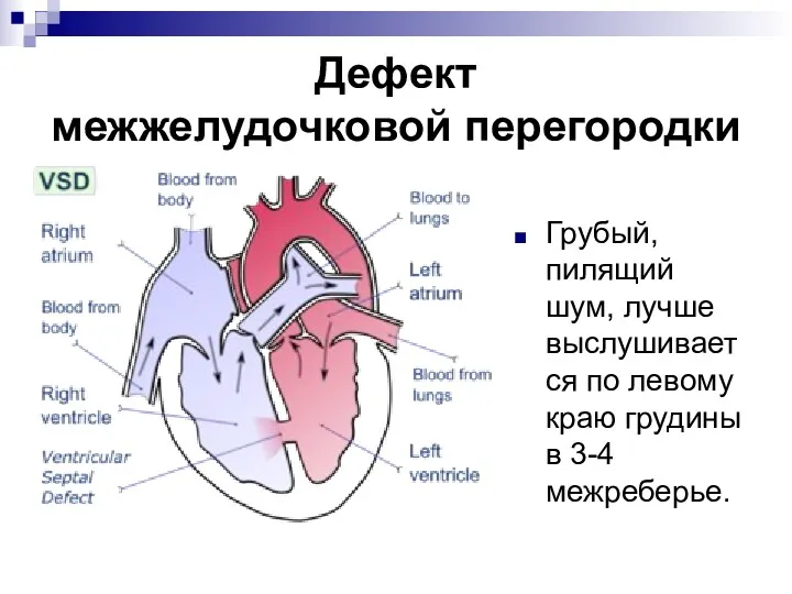 Дефект межжелудочковой перегородки Грубый, пилящий шум, лучше выслушивается по левому краю грудины в 3-4 межреберье.