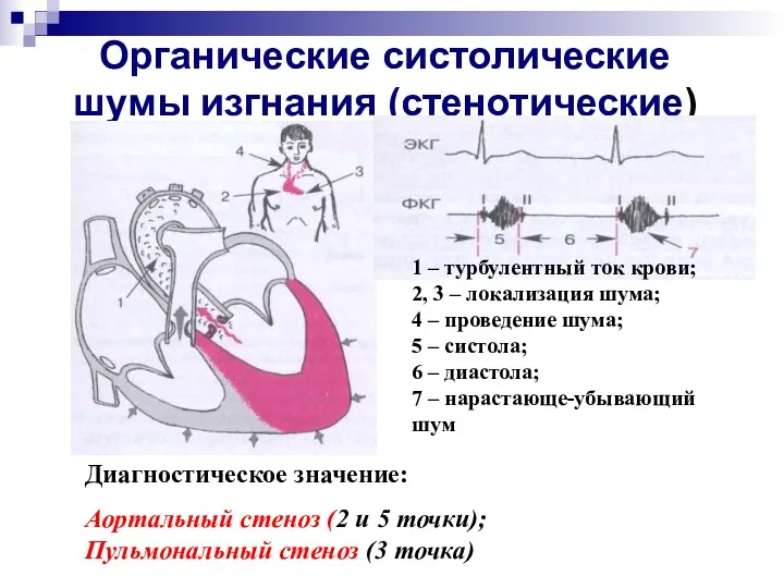 Органические систолические шумы изгнания (стенотические) 1 – турбулентный ток крови;