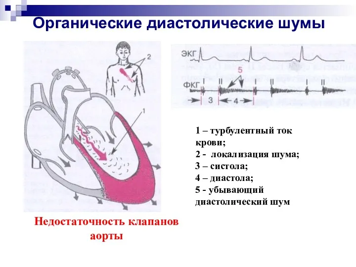 Органические диастолические шумы 1 – турбулентный ток крови; 2 - локализация шума; 3