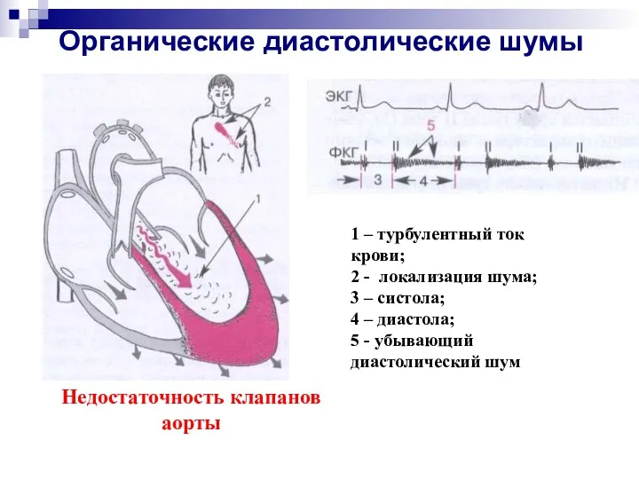 Органические диастолические шумы 1 – турбулентный ток крови; 2 -