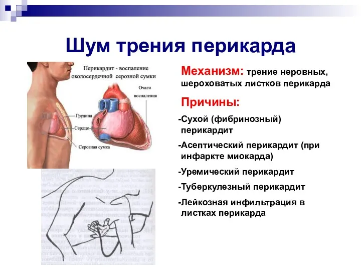 Шум трения перикарда Механизм: трение неровных, шероховатых листков перикарда Причины: