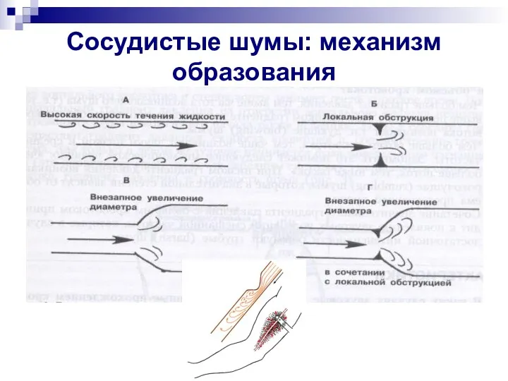 Сосудистые шумы: механизм образования